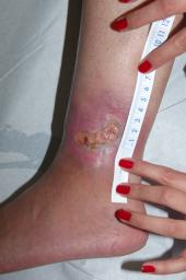 Graphical Abstract of Leg ulcers in sickle cell patients: management challenges